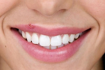 Comment traiter l’herpès labial (bouton de fièvre), les solutions naturelles?